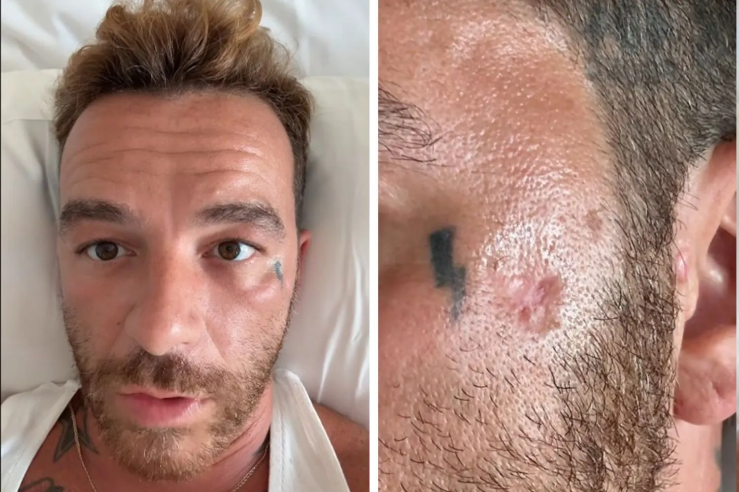 "Ho messo le creme solari e il risultato è il cancro della pelle": il racconto di Salmo riaccende la polemica sulle protezioni solari, ma la scienza dice altro