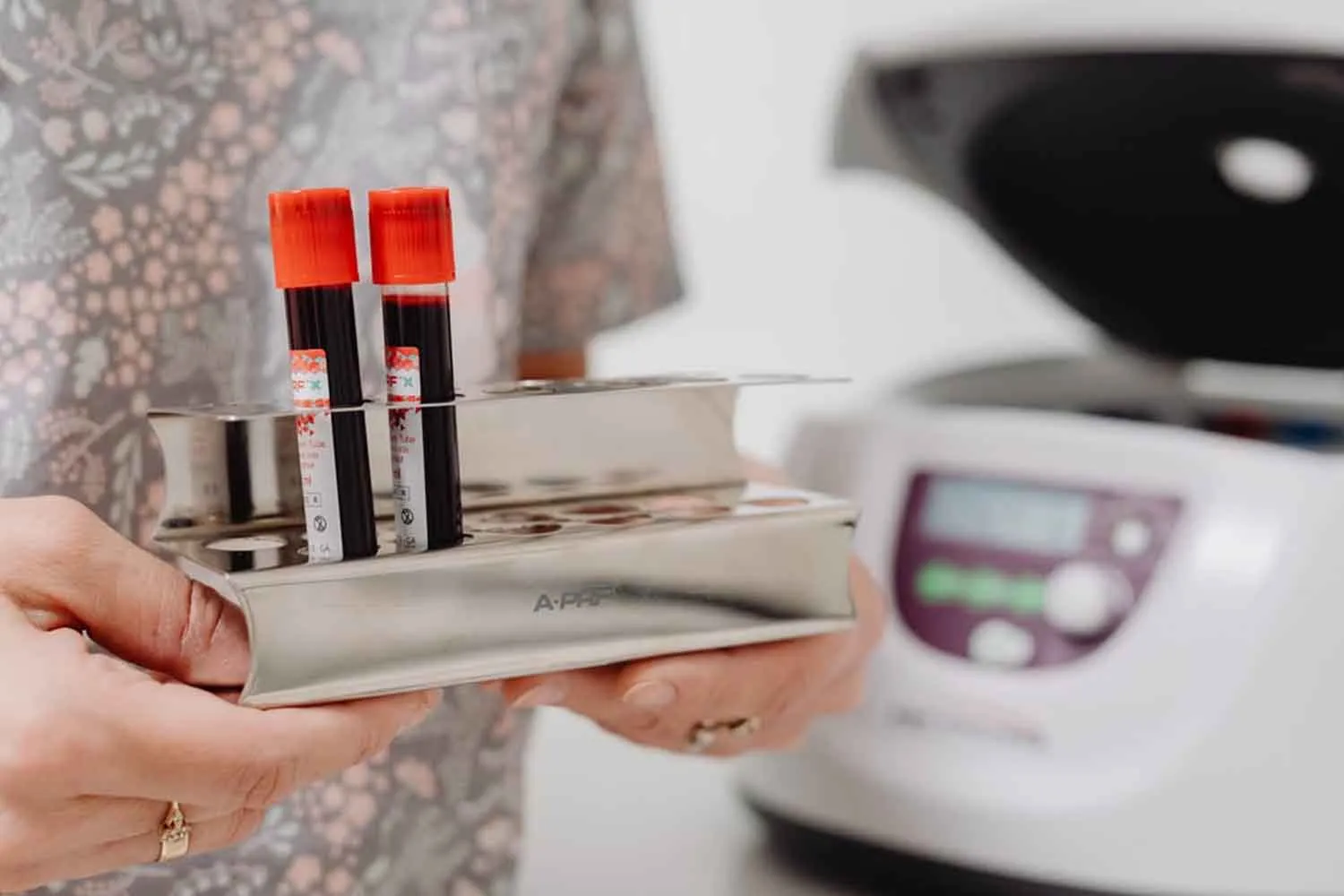 Svolta per l'Alzheimer: arriva il test del sangue dai 40 anni per chi ha già sintomi, via libera negli Usa