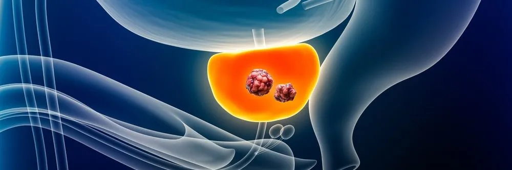 Tumore alla prostata: la radioterapia stereotassica riduce il rischio di morte del 45% - AboutPharma
